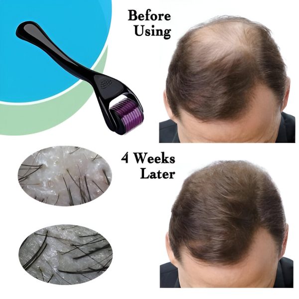Derma Roller Hair Therapy Micro-needle